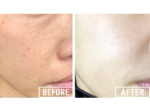 ビビ(VIVI)/ララピール症例肌質改善