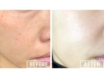 ビビ(VIVI)/ララピール症例肌質改善