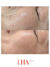 トゥインクル(Twinkle)/目指せ毛穴レス！