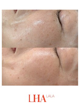 トゥインクル(Twinkle)/目指せ毛穴レス!