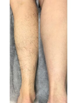 グリーンシャムロック(Green Shamrock)/脚脱毛