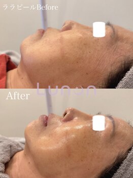 ルノン(Lunon)/ララピール