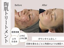 繰り返す肌荒れを陶肌トリートメントで根本改善◎