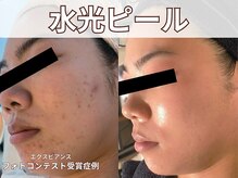 ポレ サロ(pore salo)/【水光ピール｜エクスビアンス】