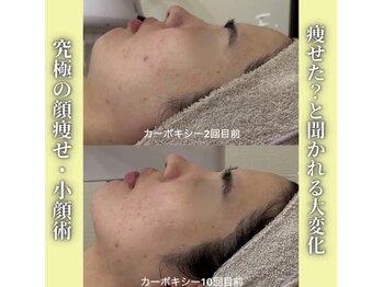 ハニエル(Haniel)/カーボキシー症例