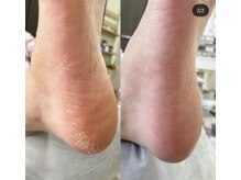 アトリエ クラシック(atelier classic)/かかと角質除去