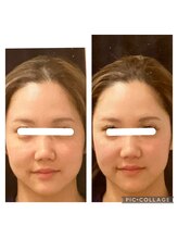 ビークレアーズ ビビ(B-crears. ViVi)/小顔矯正