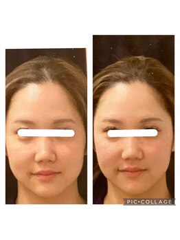 ビークレアーズ ビビ(B-crears. ViVi)/小顔矯正