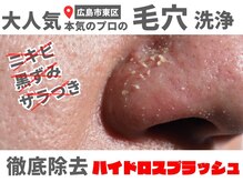 リム(reM)の雰囲気（大人気毛穴洗浄【ハイドロスプラッシュ】before～after初回¥3300）