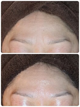 ウララ(ulala)/ピーリングでシワ改善!!