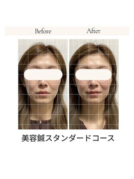 サロン ド ハリッシュ(Salon de HARISH)/フェイスラインスッキリ