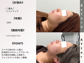 ルディラ医療提携エステ 立川店 毛穴/小顔/ニキビ・シミ・美白・シワ・たるみケア/マイクロリフト