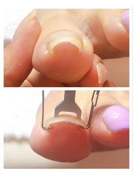 お肉に食い込んだ爪のケア