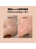 【再来】フラクショナルレーザー(100shot)毛穴の開き/凹凸改善/シミ改善