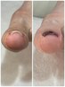【フット】≪新技術！巻き爪改善≫ワンカラー+巻き爪親指★（2本）