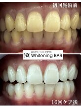 ホワイトニングバー アティ郡山店/16回照射終了ビフォーアフター