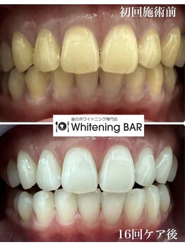 ホワイトニングバー アティ郡山店/16回照射終了ビフォーアフター
