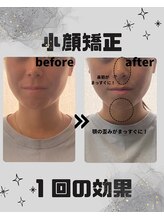 めいてる/小顔矯正/リフトアップ/大阪市