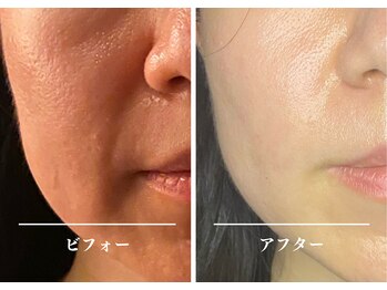 クク 赤坂 天神(99 KUKU)/施術2回目/頬のリフトアップ