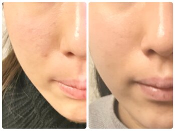 ラウン 京都(ROUN')/3回の施術ビフォーアフター