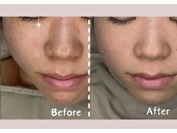 シー センター北(sii)/毛穴の黒ずみ、サヨナラ！