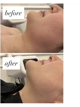 ココセンガビューティークリニック 恵比寿(COCO SENGA Beauty-Clinic)/Before/After★