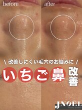 ジェノール 2nd beauty studio 姫路駅前店(JNOEL)/いちご鼻改善！毛穴ケア