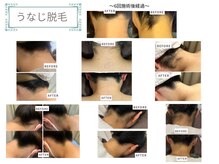 ベルスタイル(Bell style)/当店のお客様症例(うなじ脱毛)