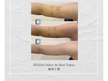 インディバホリトウキョウ(INDIBA HORI TOKYO)/術後ケアはお任せください
