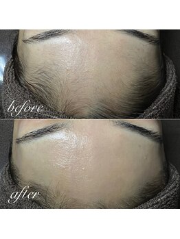 セリジェ 青山(Cerisier)/おでこもツルツルになります☆