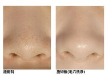 オーシャンブルー 長崎店(OCEAN BLUE)/毛穴の黒ずみケア（毛穴洗浄）
