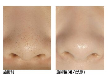 オーシャンブルー 長崎店(OCEAN BLUE)/毛穴の黒ずみケア(毛穴洗浄)