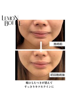 ヌナ(NOONA)/レモンボトルお客様[小顔]