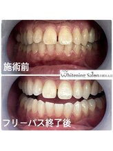ホワイトニングサロン 京都烏丸店/ホワイトニング施術例