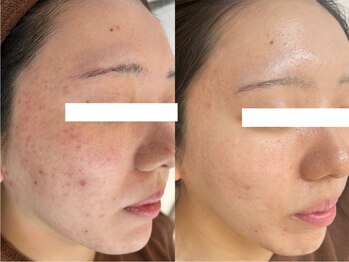 ビスキン(BeSkin)の写真/【皮脂汚れ/シミしわ/ニキビケア】に肌質から改善するハーブピーリング♪繰り返させないニキビケア◎