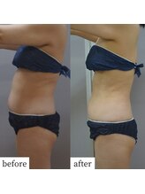 アップルミント/＜痩身＞before・after