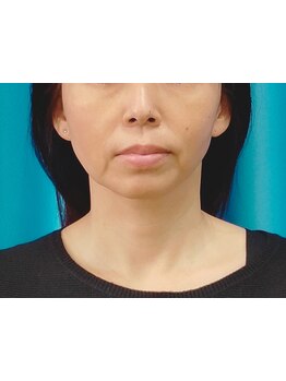 小顔になりたい