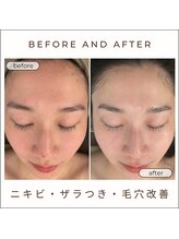 美時雨/毛穴にお悩みの方！