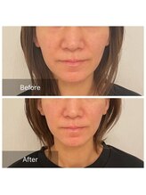 カドル 新宿店(KADORU)/小顔矯正+美容機器 Before-After