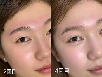 アンティエ/3回~5回は月1通ってください!