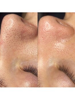 ヴィテラス バイ アリア(Veteras by aria)/☆毛穴洗浄☆