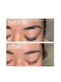 ラクシー 北千住(luxssy) 眉毛の傷跡やその他お悩みHBLで解消できます☆ご相談ください!
