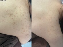 エミルカ 神戸三宮(EMILUCA)/肩のお悩み！