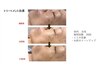 【お肌の張りと透明感を出したい方へ♪】光フェイシャル5回コース 15000円