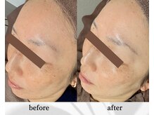 アン ビューティー(ann beauty)/【症例写真】40代女性