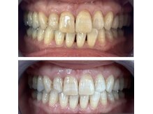 ホワイトニング美白ラボ 筑西店(ホワイトニング美白LAB)/初ホワイトニング