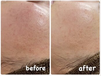 レーヴプラス 苫小牧店(REVE+)/DTありハーブピーリング