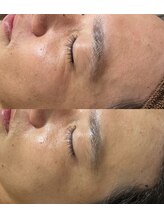 ヨルエステ(yoru aesthe)/【エイジング、シミケア】