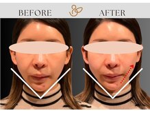 チョコバリ 錦糸町店(chocobari)の雰囲気(エラ張りさんにも!顔の余白を消す美容鍼リフトアップ/美容鍼)