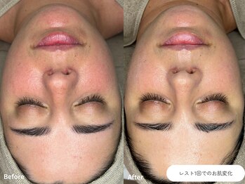 フォンビューティー(fon beauty)/日焼けケア1回